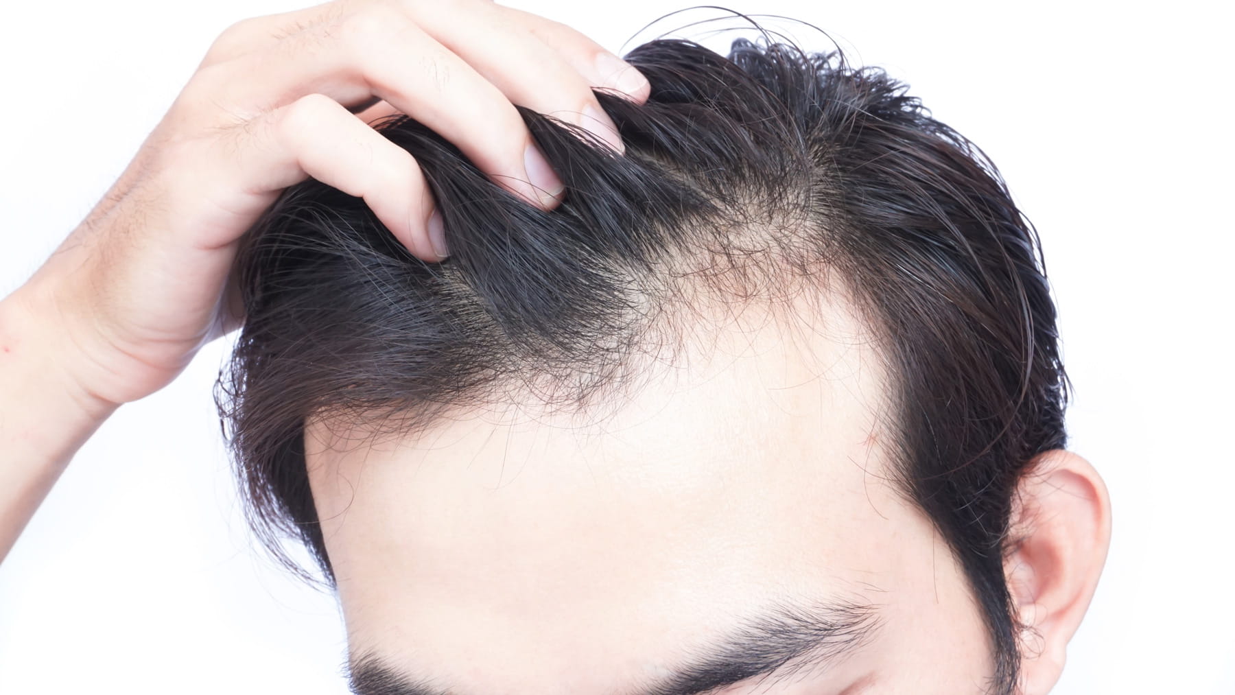 Balding scalp deals